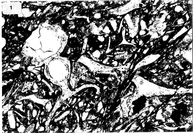 vitroklastische Struktur